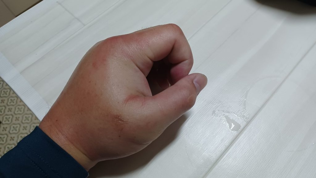 スズメバチに刺された手